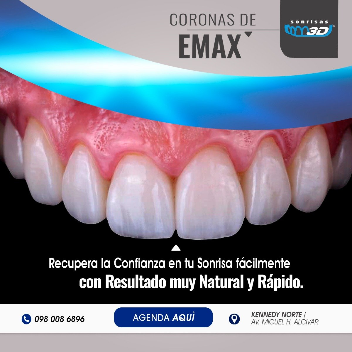 Carillas de disilicato de litio emax con brillo y translucidez natural en Guayaquil